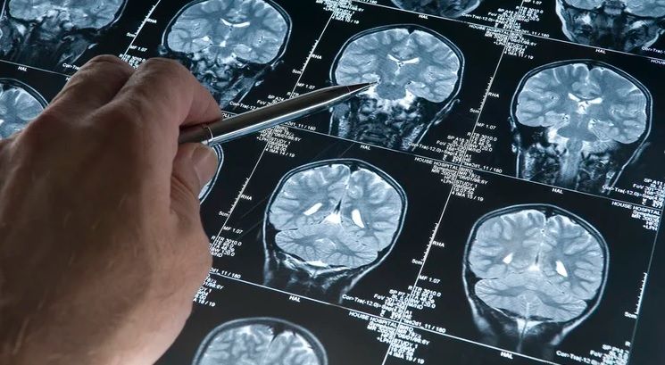 Alzheimer: aprueban un fármaco que demostró ralentizar el deterioro cognitivo